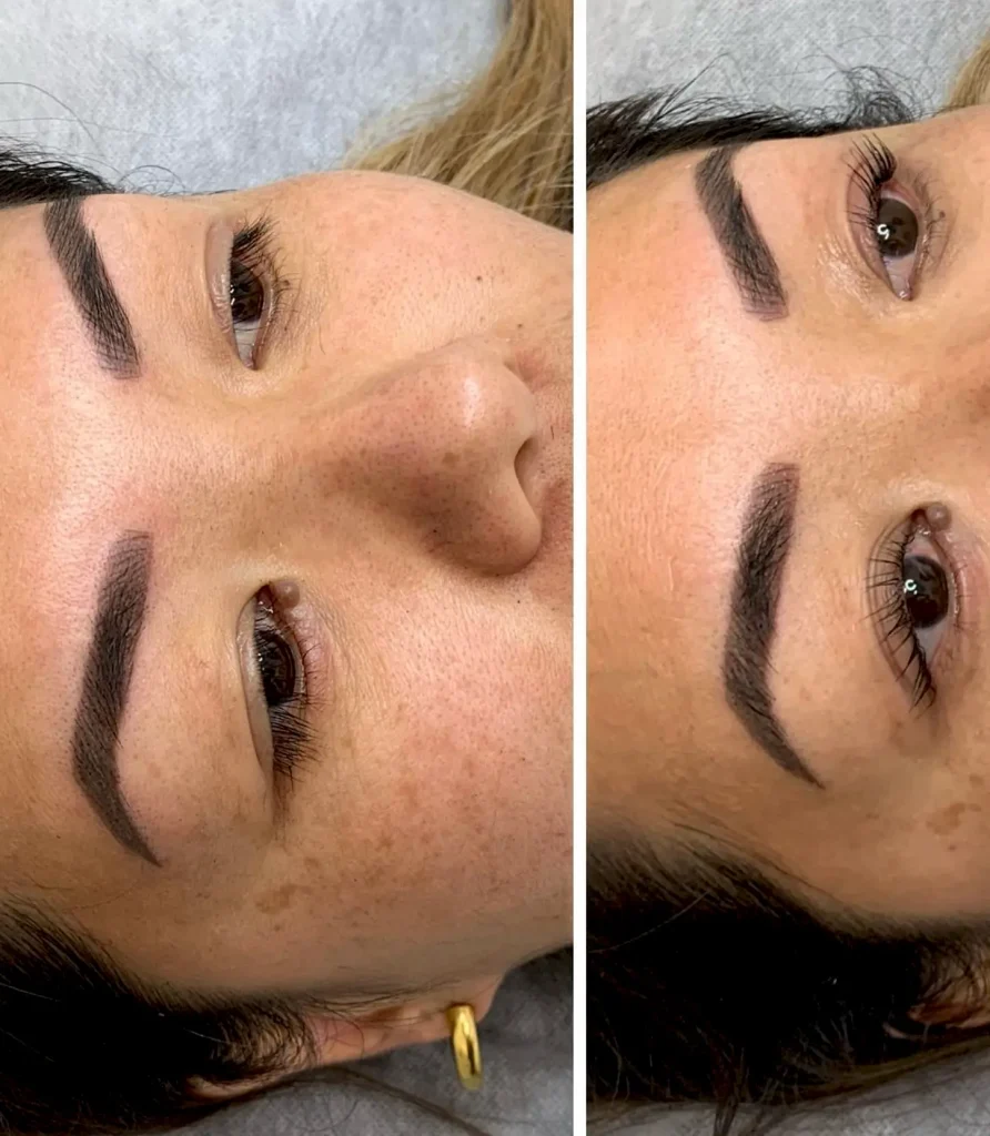 cosmetic tattooing
