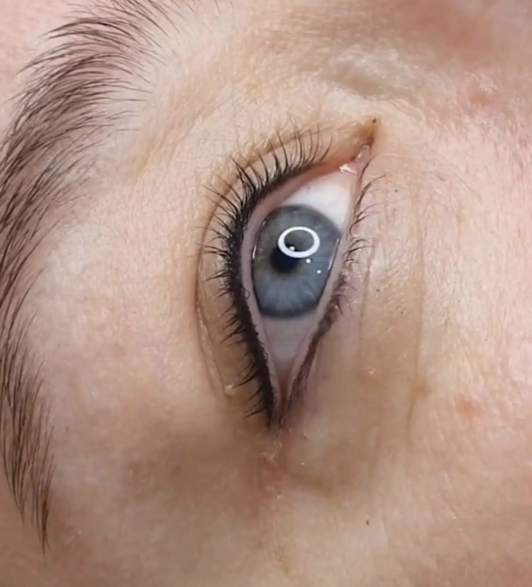 Laser eyeliner tattoo removal in Melbourne