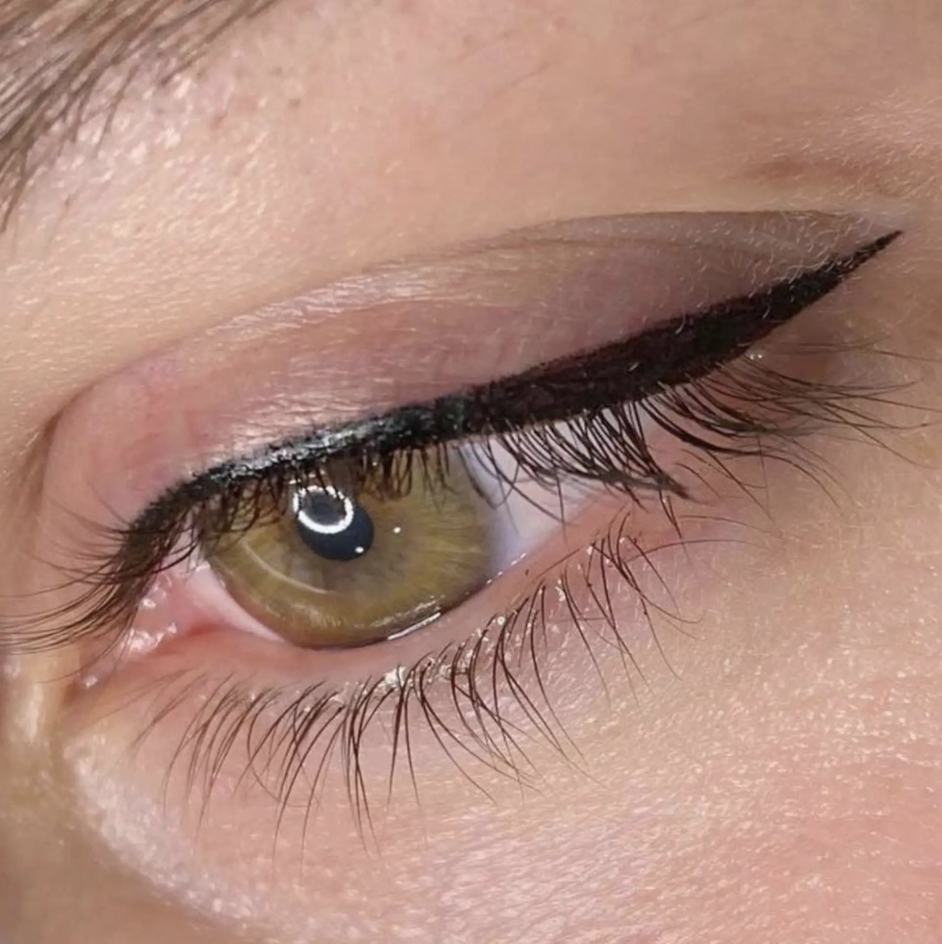 Saline removal healing on eyelid